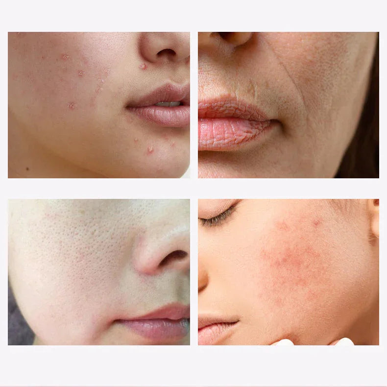 Mini Facial RF Instrument