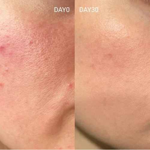 Best Red Light Mask | LED Face Mask for Anti-Aging & Skin Rejuvenation - GlintSkin