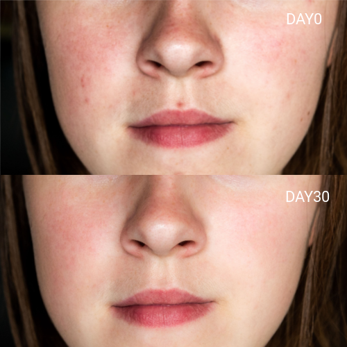 LED Light Therapy Face Mask –Classic Series